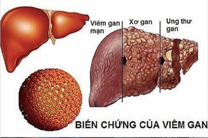 Tầm soát, phát hiện sớm ung thư gan bằng cách nào?