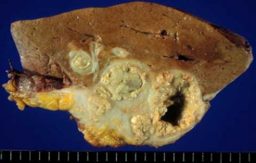 Ăn thịt chó, bị giun đũa đóng tổ phá nát não, gan