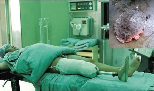 Quả báo bệnh tật bị cắt dần tay chân do thích ăn thịt rùa 