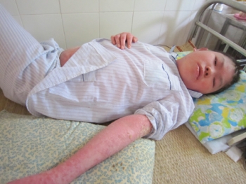 Xót thương cậu bé bị vảy nến thể mủ