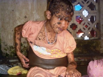 Đau lòng  với bé gái 'người thú' ở Hà Nam