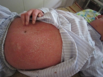 Chia sẽ kinh nghiệm trị bệnh vảy nến hiệu quả , ít tốn kém