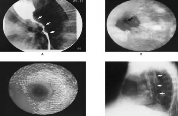 Khó nuốt, khi nào là bệnh?