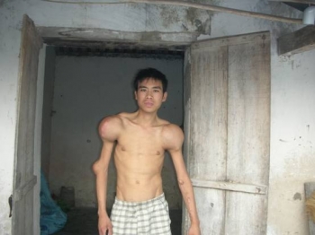 Nghệ An: Tột cùng nỗi đau của chàng trai 7 năm chạy thận