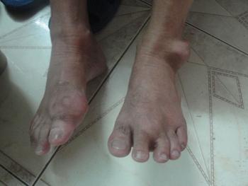 Bí mật bài thuốc chữa bệnh Gút (gout) hiệu quả