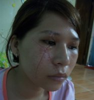 Rơi nước mắt với gia cảnh túng quẫn của nữ tiếp viên bị rạch mặt