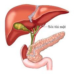 Dù đã cắt bỏ túi mật, sỏi vẫn tái phát ở gan