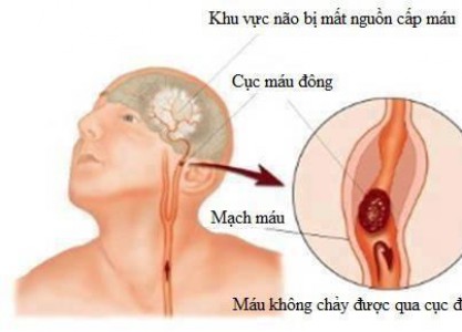 Mất vài phút mà có thể cứu được mạng người bị tai biến mạch máu não