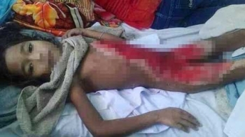 Đắng lòng em bé dân tộc bị bỏng nặng không tiền cứu chữa
