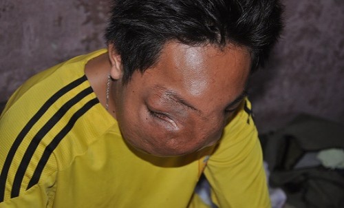 Ước mơ được cắt bỏ khối u khổng lồ của chàng trai đáng thương